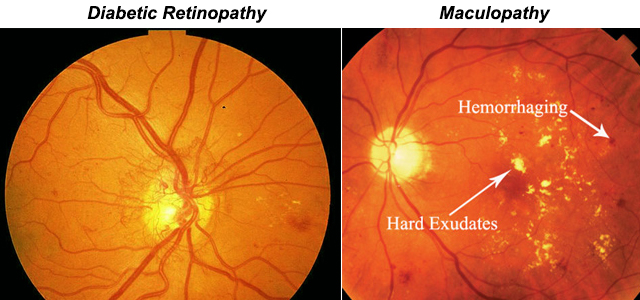 retina02