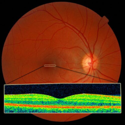 Low Vision Therapy (4)