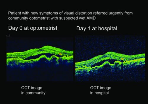 Low Vision Therapy (5)