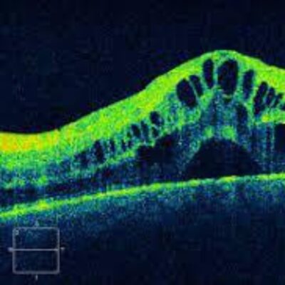 Low Vision Therapy (7)